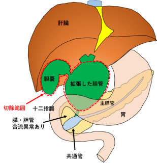 胆管拡張例（画像）