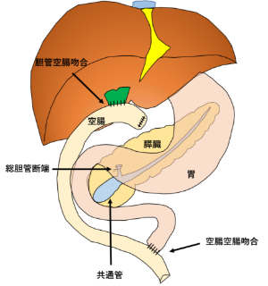 胆管拡張例（画像）