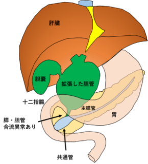 膵・胆管合流異常の典型的な解剖図（胆管拡張を伴う場合）