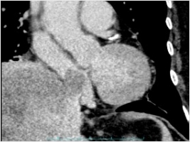 下大静脈・心房内の腫瘍栓を伴う肝細胞がんに対する肝切除術(画像1)