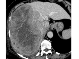 下大静脈・心房内の腫瘍栓を伴う肝細胞がんに対する肝切除術(画像3)