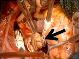 下大静脈・心房内の腫瘍栓を伴う肝細胞がんに対する肝切除術(画像4)