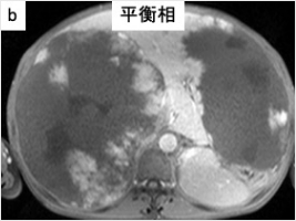 下大静脈・心房内の腫瘍栓を伴う肝細胞がんに対する肝切除術(画像5)