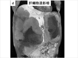 下大静脈・心房内の腫瘍栓を伴う肝細胞がんに対する肝切除術(画像6)