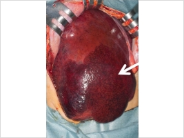 下大静脈・心房内の腫瘍栓を伴う肝細胞がんに対する肝切除術(画像7)