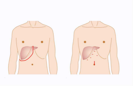 特色その1．腹腔鏡下肝切除術(画像3)
