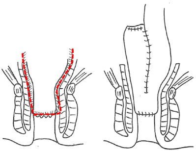 回腸嚢肛門管吻合（ IACA ）と回腸嚢肛門吻合 （IAA）