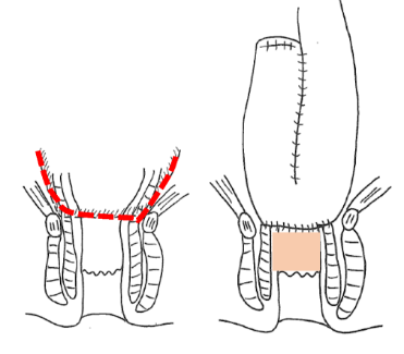 回腸嚢肛門管吻合（ IACA ）と回腸嚢肛門吻合 （IAA）
