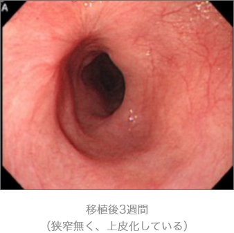 移植後3週間(狭窄無く、上皮化している)