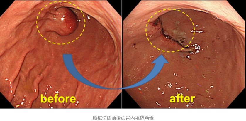 closed LECS法による腫瘍切除前後の胃内視鏡画像