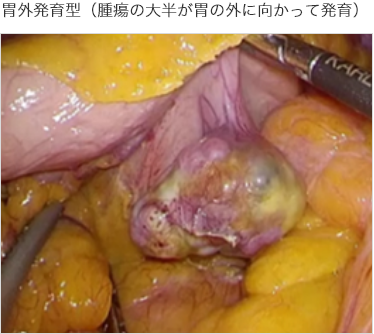 胃外発育型（腫瘍の大半が胃の外に向かって発育）