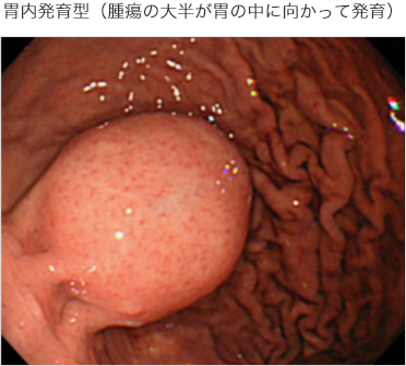 胃内発育型（腫瘍の大半が胃の中に向かって発育）