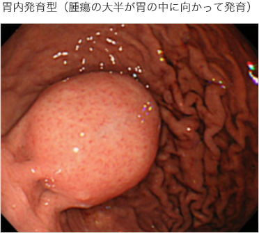 胃内発育型(腫瘍の大半が胃の中に向かって発育)